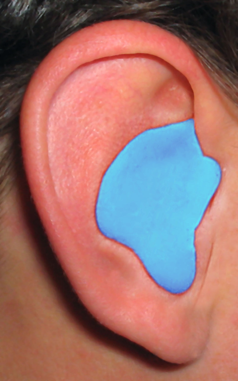 Tapones para los oídos moldeados personalizados